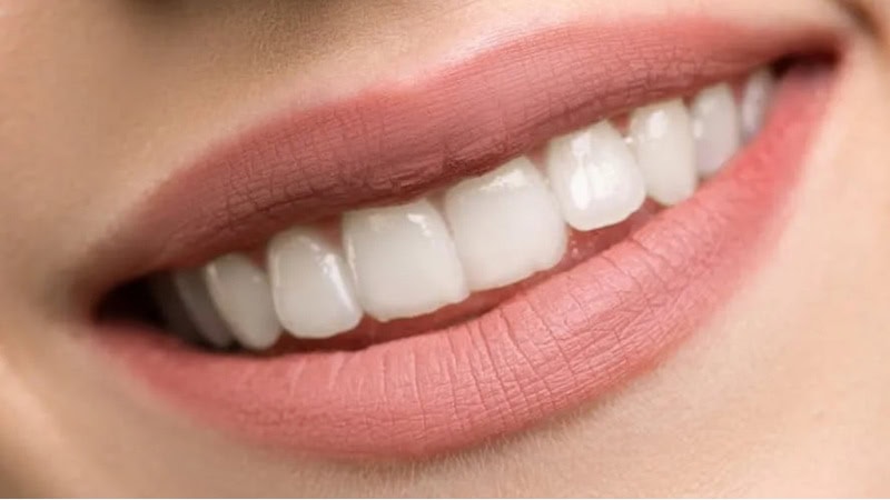 Hipoplasia del esmalte