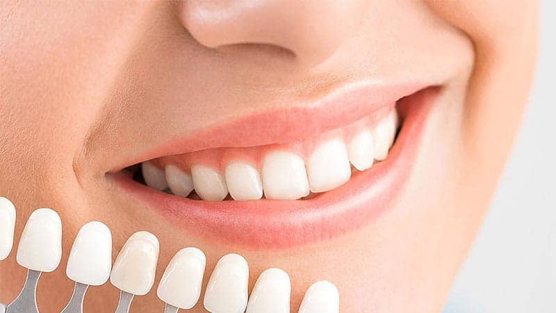 Cuánto dura un blanqueamiento dental